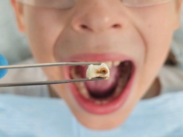 Best Emergency Root Canal Treatment in Rosedale, MD